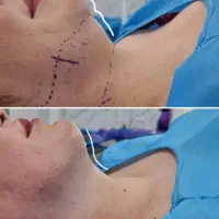 جشنواره ویژه ساکشن غبغب