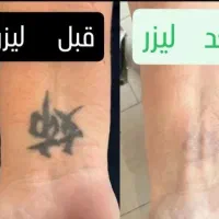 پاک کردن تتو با پیشرفته ترین لیزر کیوسوئیچ|خدمات آرایشگری و زیبایی|اهواز, کوی سعدی|دیوار
