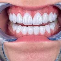 جشنواره کامپوزیت دندان ، ایمپلنت و درمانی اقسا/طی