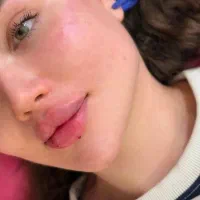 تزریق چربی ، تزریق ژل ، بوتاکس ، جراحی در مطب|خدمات آرایشگری و زیبایی|نورآباد, |دیوار