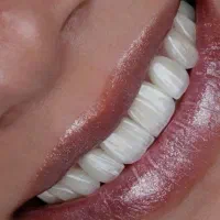 دندانپزشکی،ایمپلنت، اوردنچر