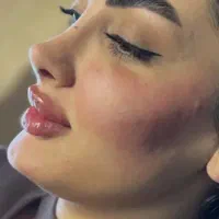 تزریق ژل و بوتاکس