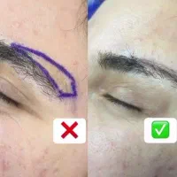 آموزش بلفاروپلاستی لیزری