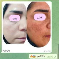 سرم نیاسینامید ضد لک وجوش|آرایشی، بهداشتی، درمانی|شیراز, باغ تخت|دیوار