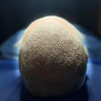 کاشت مو فول تراکم و اقساطی با شرایط ویژه