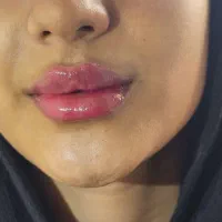 تزریق بادی فقط سی سی۵۰هزار