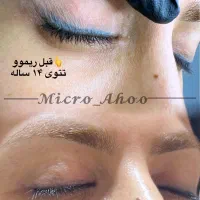 پاک شدن تتوهای قدیمی صورتت با من