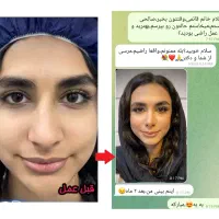 عمل جراحی بینی بامتخصص گوش،حلق،بینی|خدمات آرایشگری و زیبایی|تهران, یوسف‌آباد|دیوار