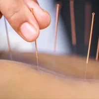 طب سوزنی تخصصی(اکوپانچریست)،امبدینگ لاغری|خدمات زیبایی و سلامت|تهران, دبستان|دیوار