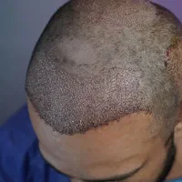 کاشت مو«رویان کاشت»|خدمات آرایشگری و زیبایی|رشت, بوسار|دیوار