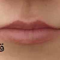 بوتاکس صورت وژل لب مزودلینگ صورت زاویه سازی فک