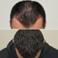 کاشت مو، ابرو، ریش حرفه ای توسط پزشک متخصص پوست مو|خدمات آرایشگری و زیبایی|شیراز, قدوسی غربی|دیوار