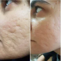جوانسازی صورت با بهترین متریال و بروز ترین دستگاه|خدمات آرایشگری و زیبایی|گرگان, |دیوار
