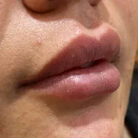 تزریق فیلر،ژل،بوتاکس،چالگونه تخفیف 50 درصدی