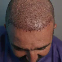 کاشت تخصصی مو به روش FIT|خدمات آرایشگری و زیبایی|رشت, گلسار|دیوار