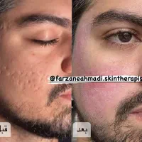 درمان کک ومک/درمان لک/درمان جوش/ردبخیه/اسکار|خدمات آرایشگری و زیبایی|قدس, شهر‌قدس|دیوار