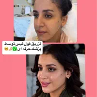 تخفیفات طلایی/ژل لب/ بوتاکس/ گونه/ فول فیس خط خنده