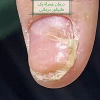 کاشت ناخن درمان ناخن کفسابی پارافینتراپی. اموزش|خدمات آرایشگری و زیبایی|مشهد, صیاد شیرازی|دیوار