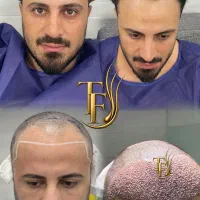 کاشت مو ساری
