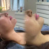 تزریق ژل و بوتاکس تابستانه|خدمات زیبایی و سلامت|تهران, عبدلآباد|دیوار