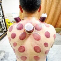 کسالت وخستگی بدن خودرابا حجامت برطرف کنید