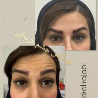 بوتاکس ژل فیلر چربی بلفاروپلاستی مزو PRP نخ لیزر|خدمات آرایشگری و زیبایی|شاهین‌شهر, فردوسی|دیوار