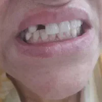 ساخت دندان مصنوعی فلیپر (تک واحدی و دو واحدی)