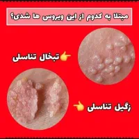 درمان ریشه ای زگیل و تبخال به صورت گیاهی