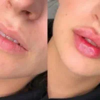 تخفیف عیدانه ژل و بوتاکس