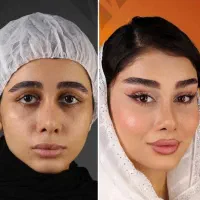 بلفاروپلاستی لیفت صورت بوکال فت تزریق چربی