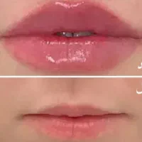 تزریق ژل و بوتاکس.. با بهترین مواد و کمتری قیمت.