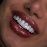 کامپوزیت دندان از دم قسط|خدمات آرایشگری و زیبایی|تهران, بلوار کشاورز|دیوار