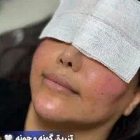 تزریق چربی به صورت وساکشن شکم وپهلو|خدمات آرایشگری و زیبایی|نهاوند, |دیوار