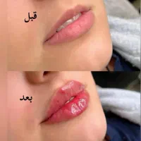 برداشتن خال۱۰ هزار تومن دریک جلسه،فیلر۳۹۰،جوانسازی|خدمات آرایشگری و زیبایی|کرج, گوهردشت|دیوار