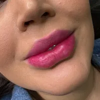 تزریق ژل لب روسی /فول فیس/شقیقه/بوتاکس، آنزیم|خدمات آرایشگری و زیبایی|تهران, فلاح|دیوار