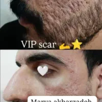 درمان لک جوش جای جوش دائمی