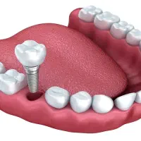 جشنواره‌ایمپلنت پایه قیمت ۷۹۰۰/کیفیت /ضمانت|خدمات آرایشگری و زیبایی|کرمانشاه, |دیوار