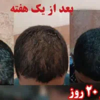درمان ریزش مو قطعی|فعالیت داوطلبانه|قیدار, |دیوار