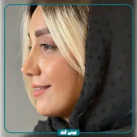 جراحی زیبایی بینی فقط و فقط ۴۰ میلیون تومان