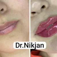 تخفیفات فیلر/ژل/بوتاکس/جوانساز