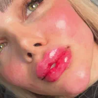 تزریقات ژل و بوتاکس|خدمات آرایشگری و زیبایی|گرگان, |دیوار