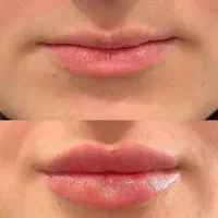 تزریق ژل و بوتاکس|خدمات آرایشگری و زیبایی|کرج, گلشهر|دیوار