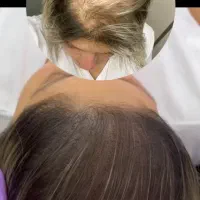 تخفیف‌میکرواسکالپ‌سر(کاشت‌مو)آرایشدائم‌تینت/رژدائم