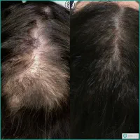 پی آر پی و مزوتراپی مو و ابرو|خدمات آرایشگری و زیبایی|اردبیل, |دیوار