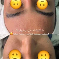 درماپلنینگ تخصصی صورت|خدمات آرایشگری و زیبایی|زابل, |دیوار