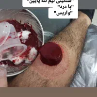 زالو درمانی،حجامت