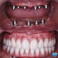 دندان پزشکی/ ایمپلنت بدون بخیه/اوردنچر/روکش