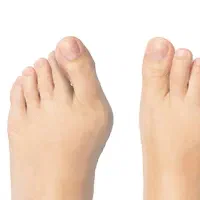 کلینبک درمان هالوکس والگوس (شصت پای کج)|خدمات آرایشگری و زیبایی|قروه, |دیوار