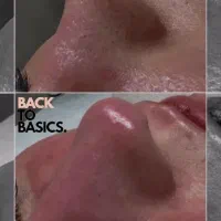 آفر پاکسازی صورت|خدمات آرایشگری و زیبایی|مشهد, ادیب نیشابوری (شهرک غرب)|دیوار