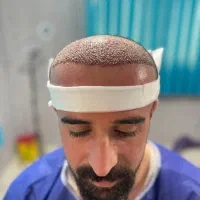 کاشت مو،ابرو،ریش